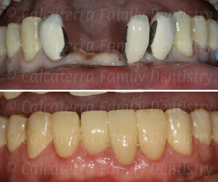 High quality before and after photos showing a new smile.