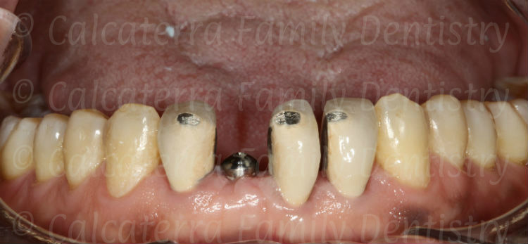 lower incisor crowns after orthodontic treatment