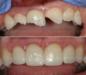 Before and after photo of front teeth after trauma