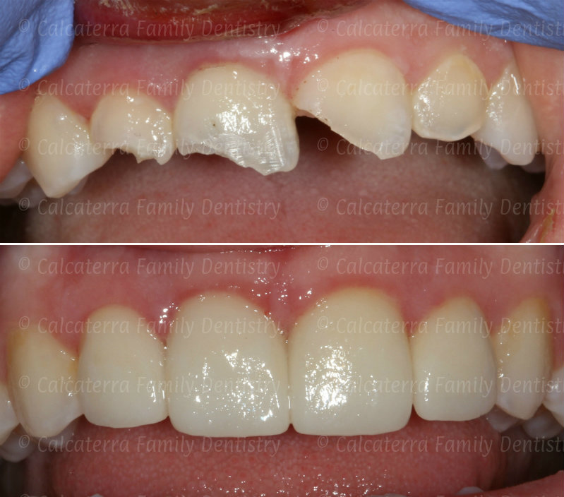 Before and after photos after trauma of front teeth