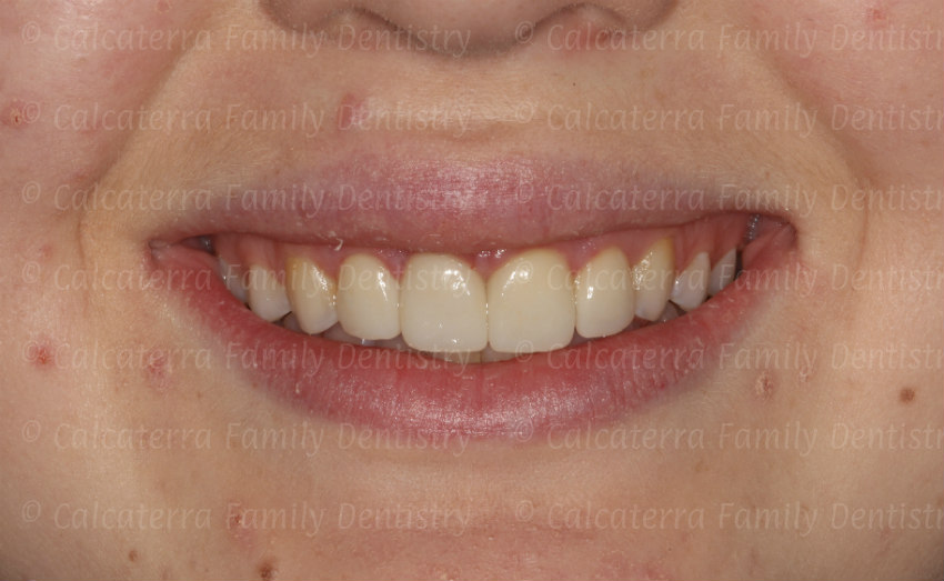 Smile after trauma with crowns and veneers