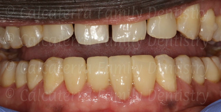 four crowns on lower incisors with an implant