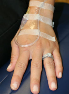 IV in the hand for intravenous sedation dentistry with midazolam (versed) in Connecticut
