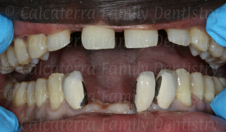 photo of lower bridge sectioned showing ugly incisor crowns