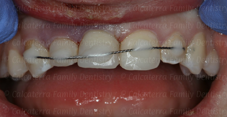 Front teeth splinted with ortho wire due to trauma