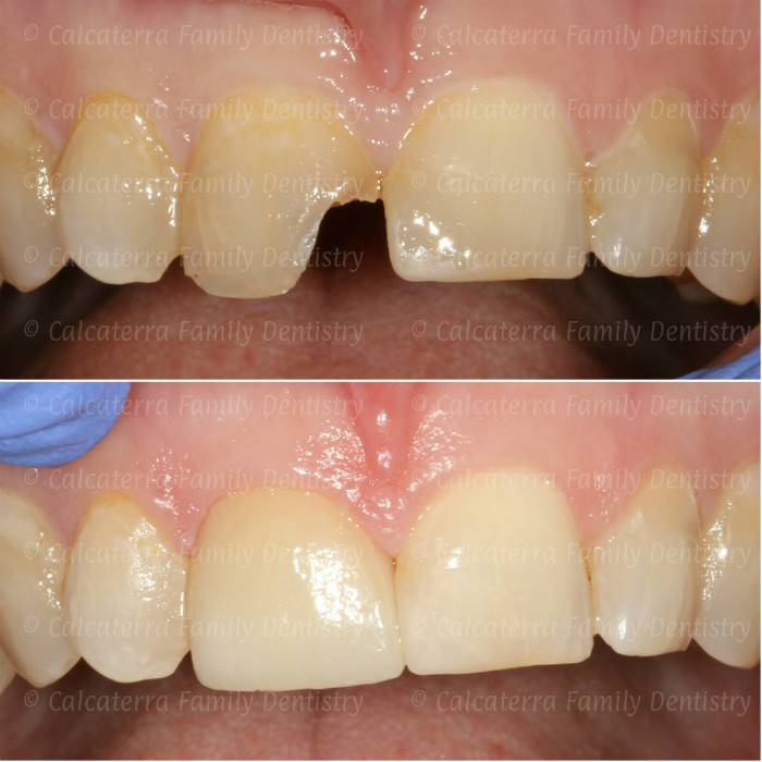 before and after photos showing a single central incisor crown