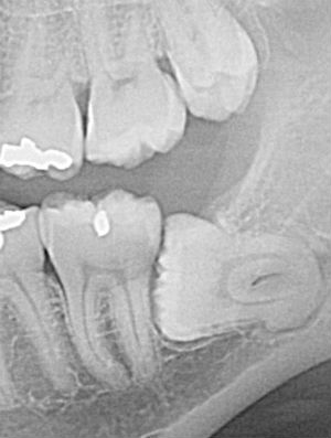 Impacted lower wisdom tooth that will be painful the next day after removal