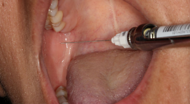mandibular nerve block lower third molar removal