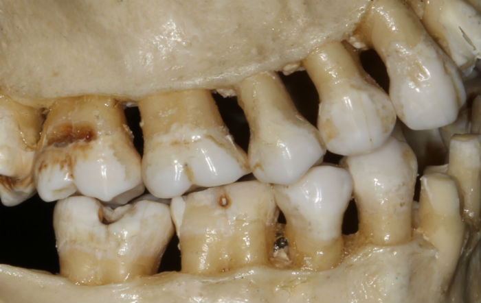 bone impacts why lower wisdom teeth hurt more