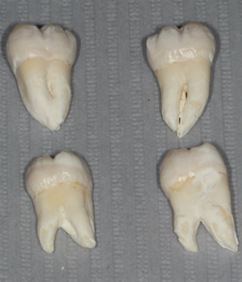 upper versus lower wisdom teeth which cause pain