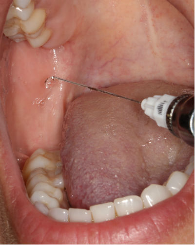 Dental injection photo with big needle