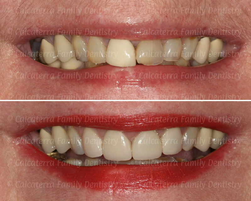 Before and after veneers and crowns photo