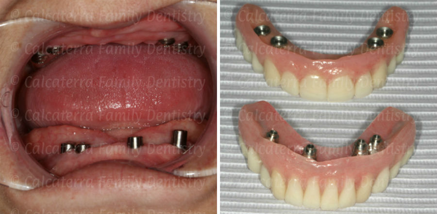 Implants to retain a fixed complete upper and lower denture.