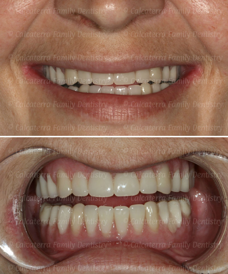 Smiling photo showing fixed implant complete dentures