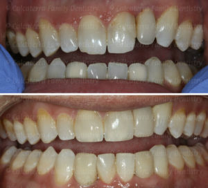 Before and after photos of Mark's new smile