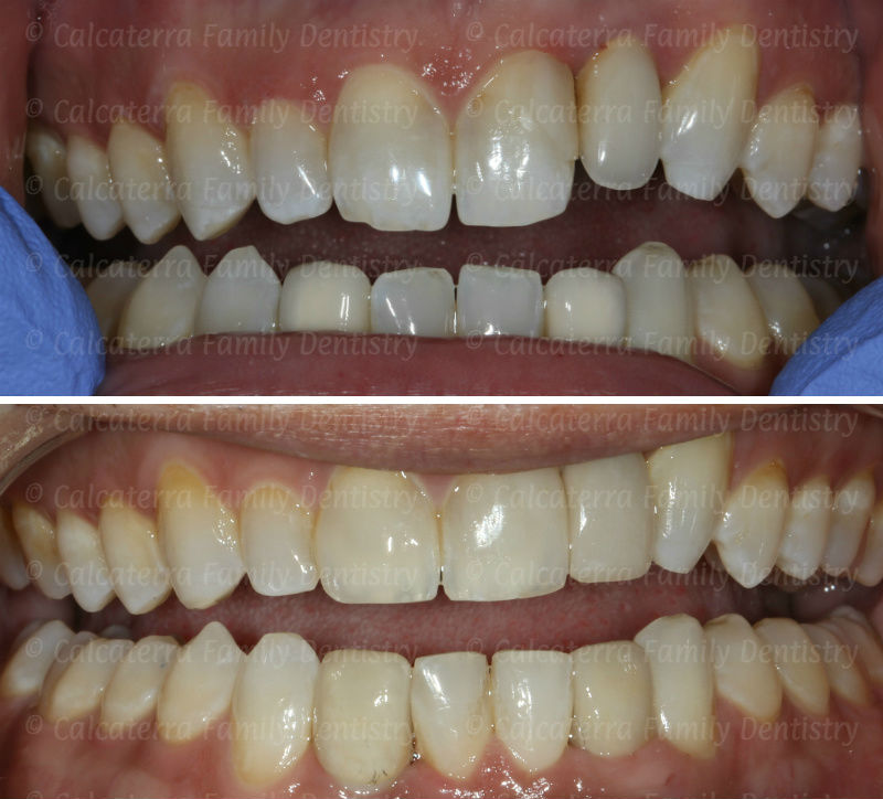 Before and after photos of implant crowns and esthetic recontouring of teeth.