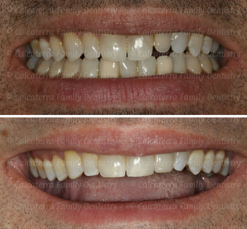 Before and after smiling teeth photos