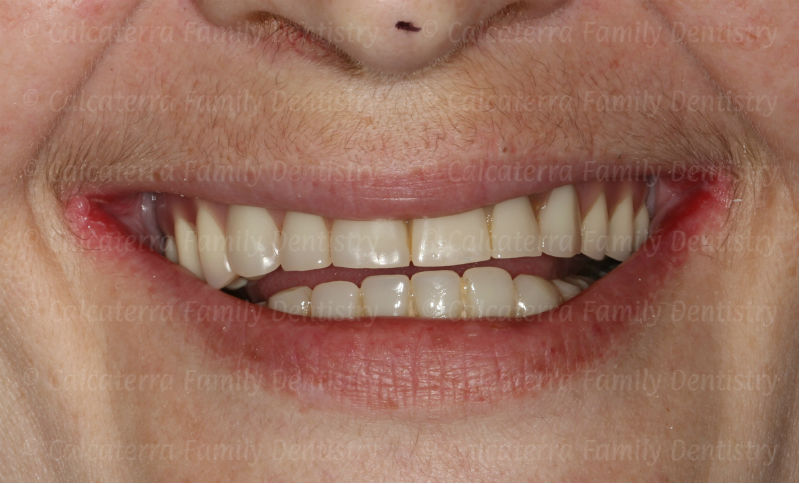 Smile of a patient with a poorly shaped implant retained fixed upper denture.