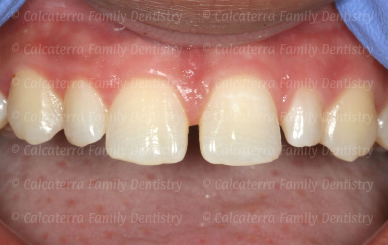 Photo showing diastema or gap between her teeth.