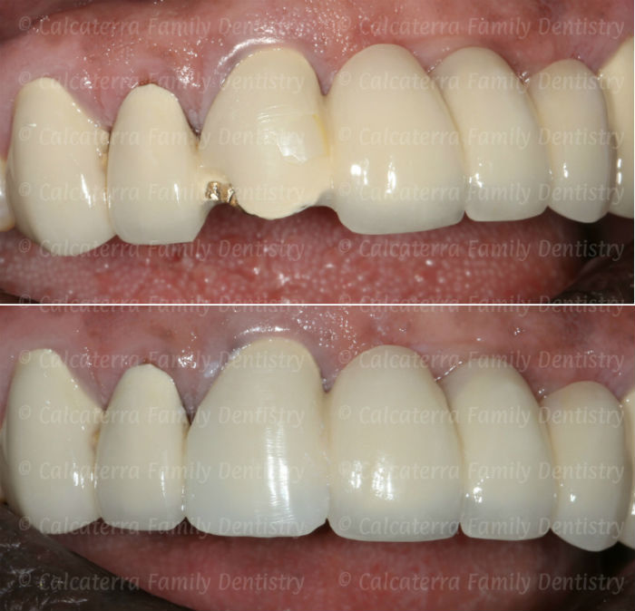 Before and after photo porcelain fracture repair of front dental bridge