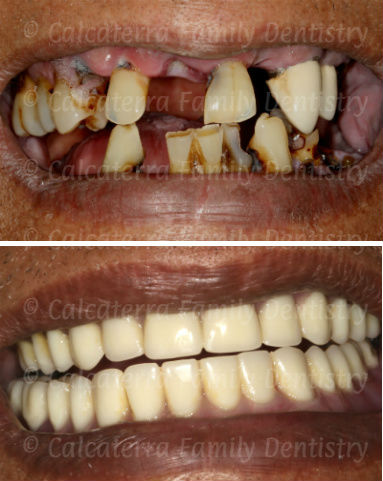 full mouth extraction of bad teeth to new dentures