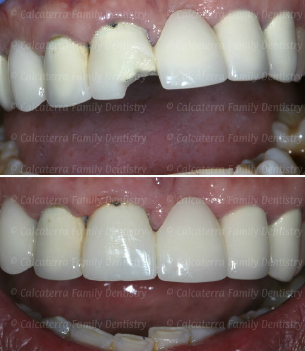 Before and After photo showing porcelain repair of a chipped dental bridge