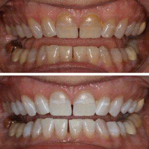 Kor Whitening before and after done in Orange CT