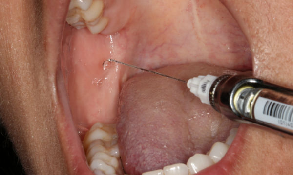 Dental shot for a lower tooth can cause pain while opening